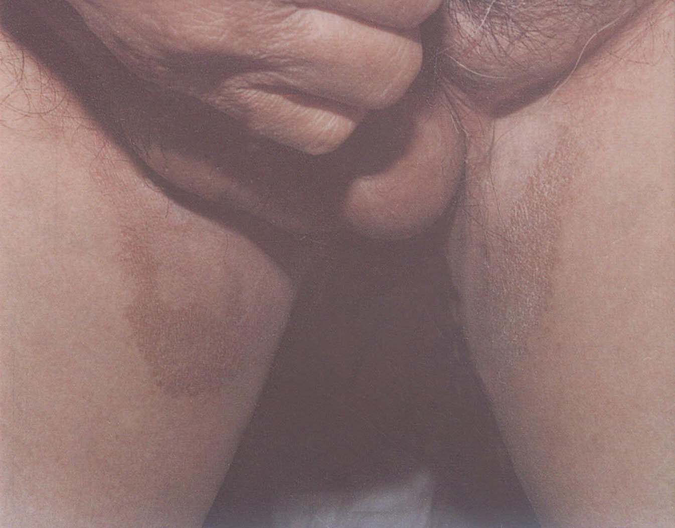 紅癬